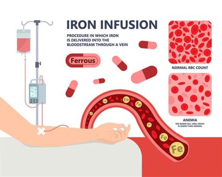 Can an iron infusion cause iron overload?