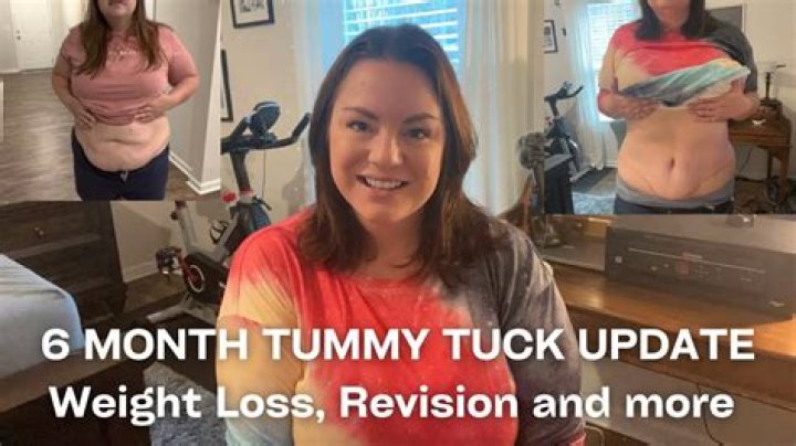 Do you lose weight with tummy tuck
