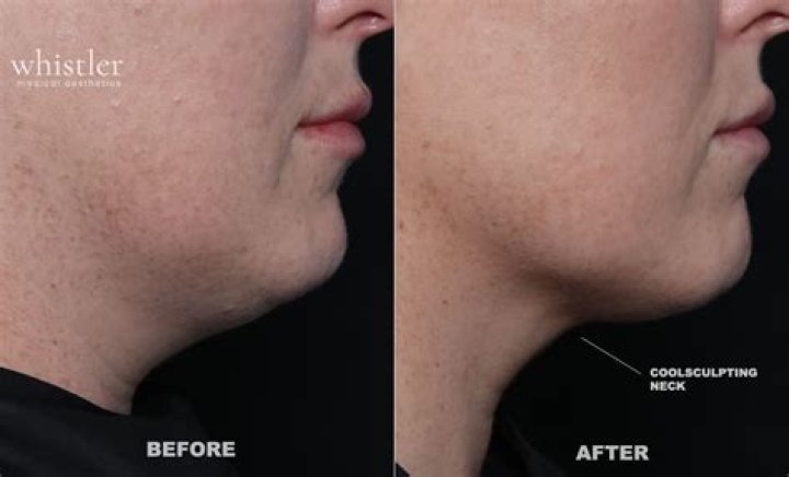 Does CoolSculpting work on chin and neck?