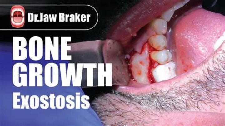 How do you promote bone growth after surgery?