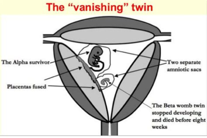 Is a vanishing twin considered a miscarriage?
