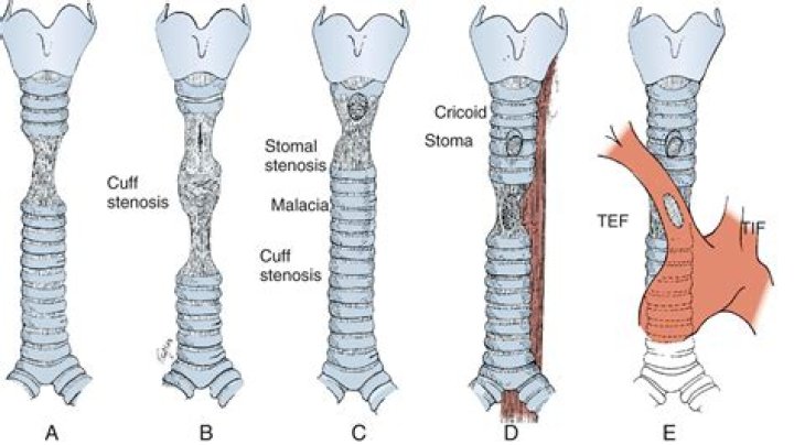 Is tracheal collapse fatal? | ContextResponse.com