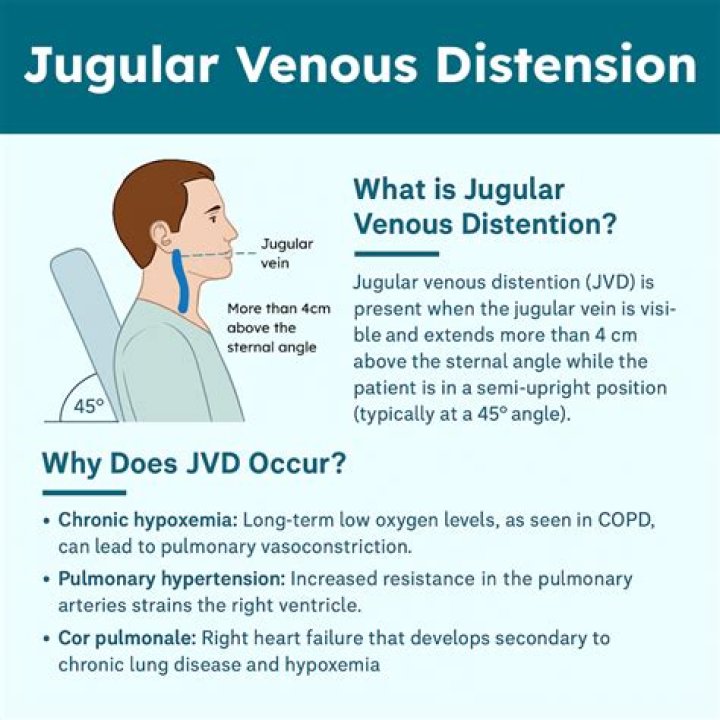 What does a positive JVD mean