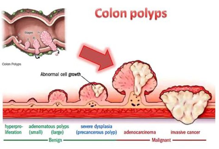 What does it mean when a polyp is sessile?