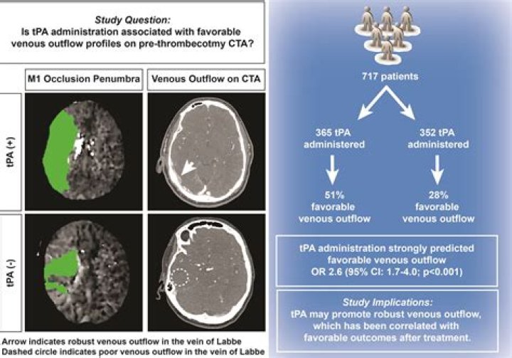 What is IV tPA for stroke