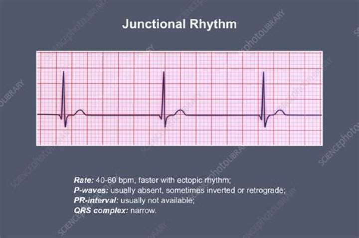 What is junctional bradycardia