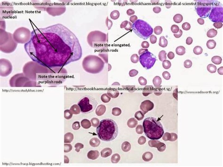 What leukemia has Auer rods?